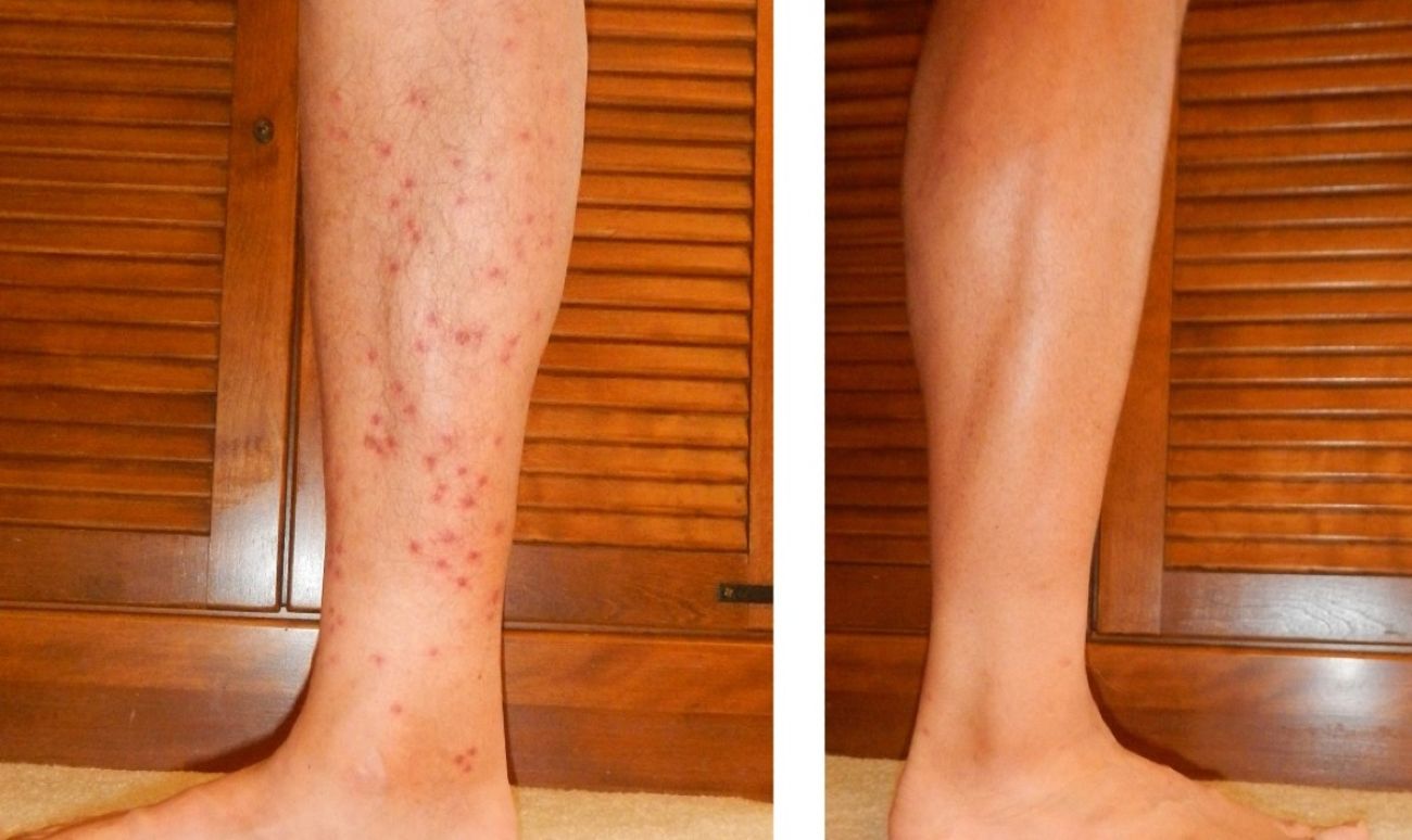 A side-by-side image showing a leg infected with swimmer's itch on one side and not infected on the other